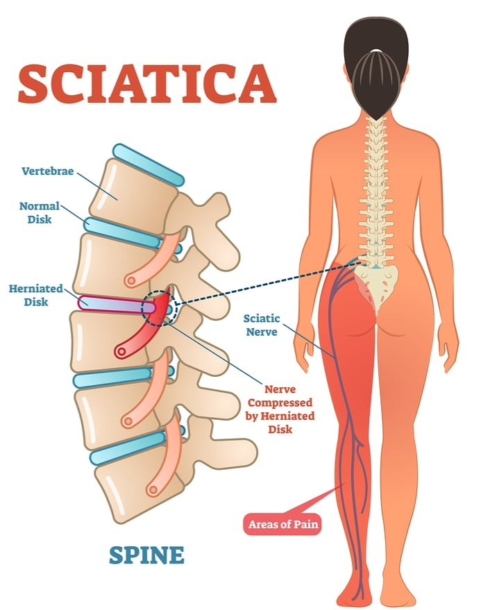 Sciatica Symptoms Including Back Pain and Leg Cramps