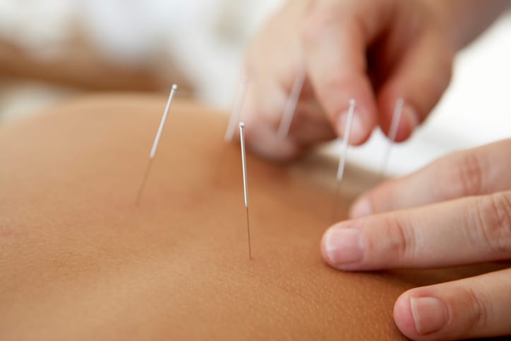 Acupuncture