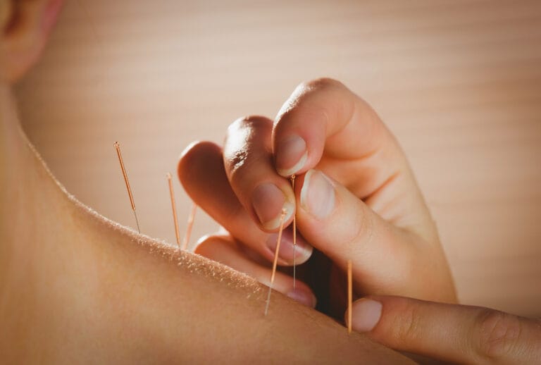 Acupuncture needles being inserted into a person's shoulder
