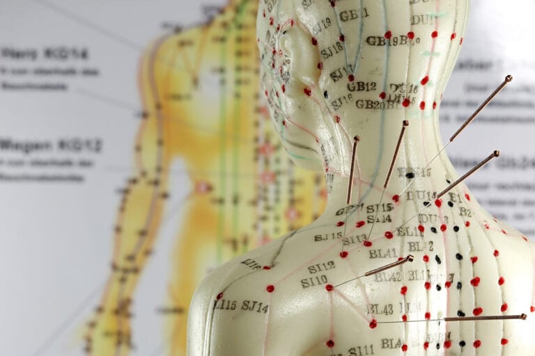 Acupuncture model torso with inserted needles and meridian points